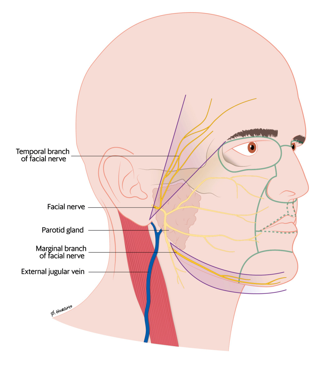 Figure 1 Temporal branch of facial nerve, marginal branch of facial nerve and external jugular vein. The boundaries between&hellip;