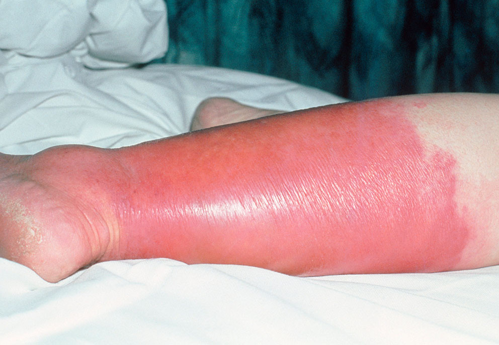 Figur 1 Cellulitt. Foto: Science Photo Library / NTB