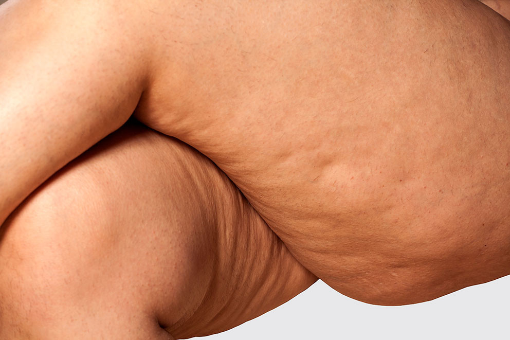 Figur 2 Cellulitter (gynoid lipodystrofi). Foto: VladimirFLoyd/iStock. Tilpasset av Tidsskriftet