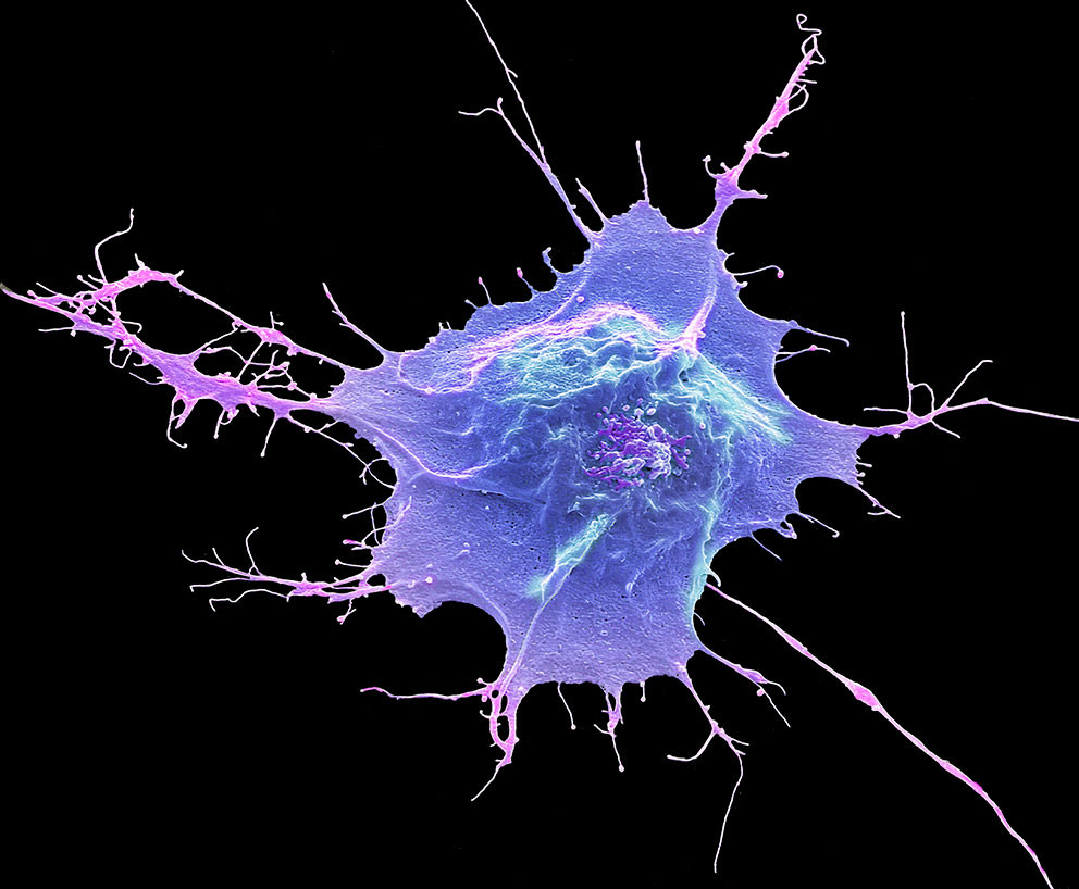 Indusert pluripotent stamcelle. Farget bilde fra sveipelektronmikroskopi (SEM). Illustrasjonsfoto: Science Photo Library /&hellip;
