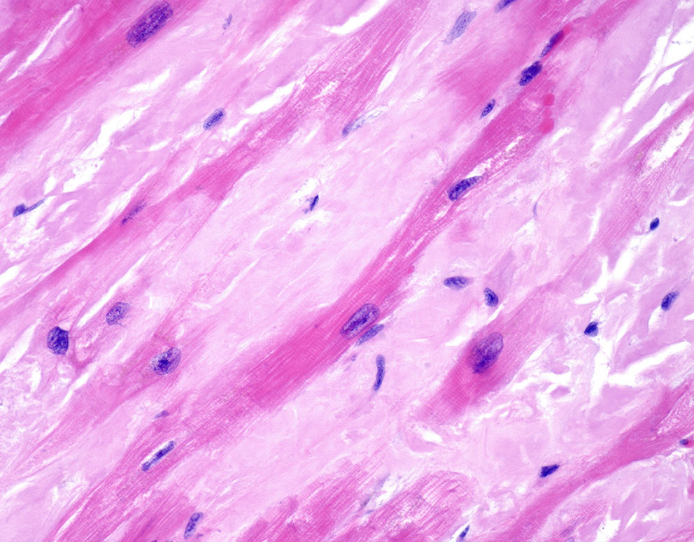 Amyloidose, lysmikrofotografi. Illustrasjonfoto: Science Photo Library / NTB