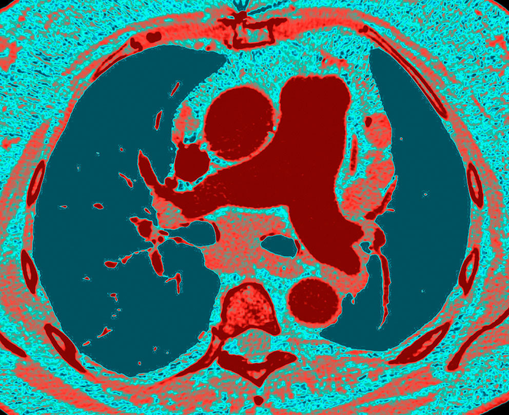 Pulmonal arteriell hypertensjon, CT. Illustrasjonsfoto: PNMB / Science Photo Library / NTB
