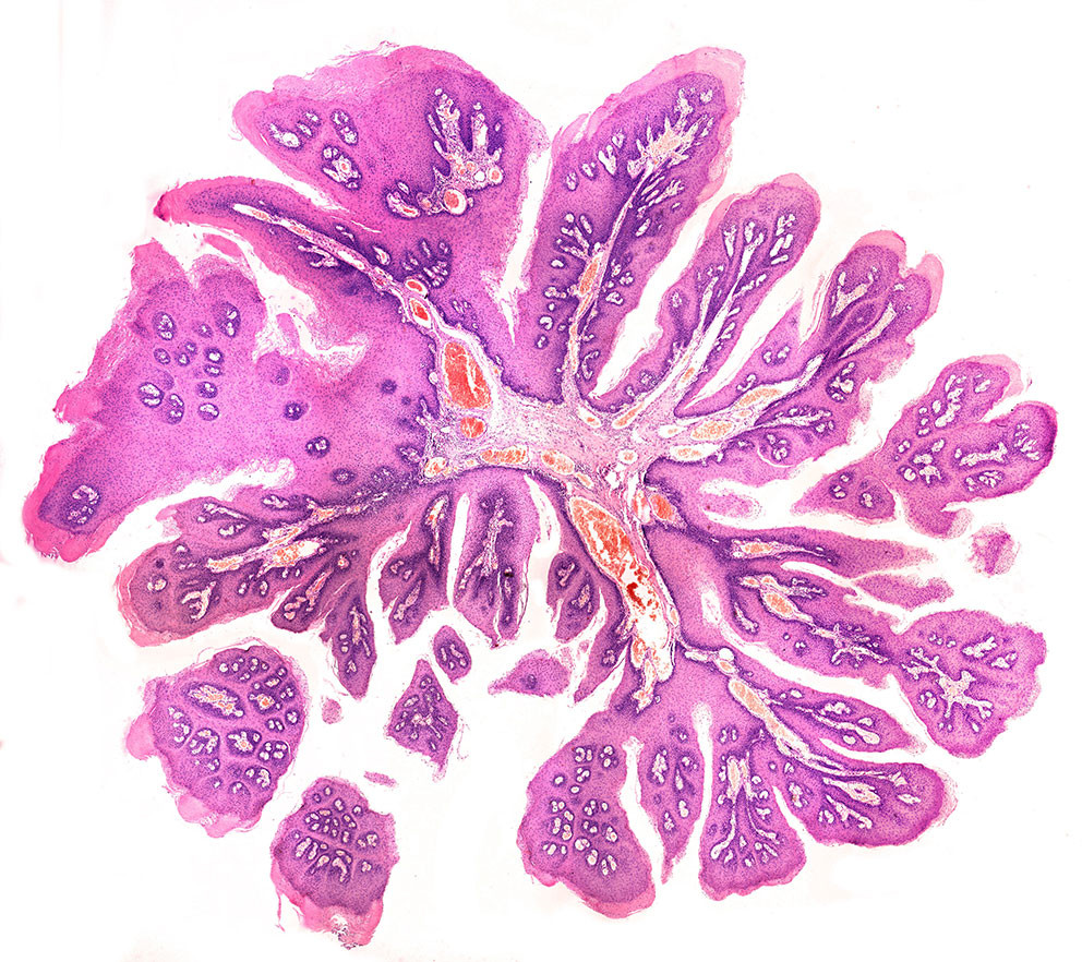 Illustrasjonsfoto: Papillom, lysmikroskop. Foto: Science Photo Library / NTB