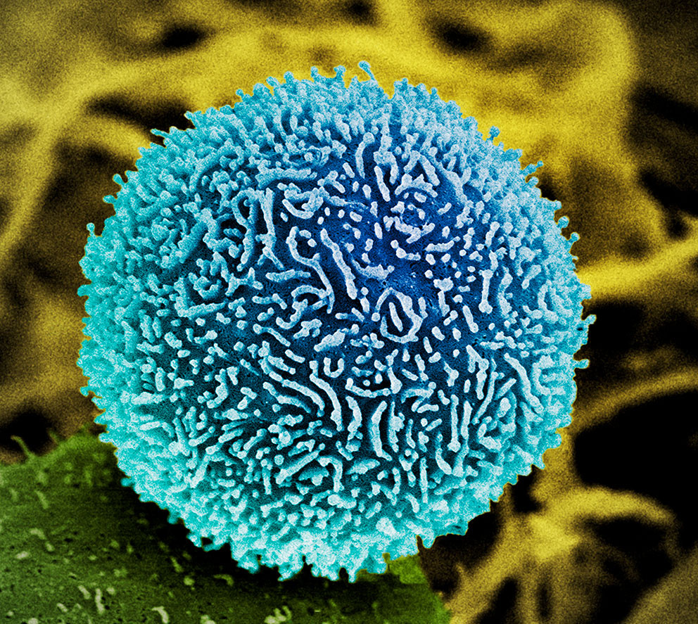 Pankreaskreft, elektronmikroskop. Illustrasjonsfoto: Science Photo Library / NTB