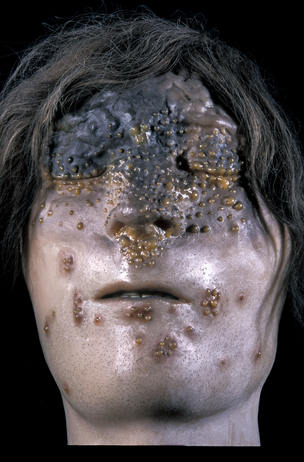 Modell med eksempel p&aring; snive, for&aring;rsaket av Burkholderia mallei. Foto: Science Photo Library / NTB